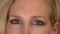 ThermaCool Non-Surgical Facelift before and after photo