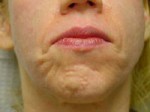 ThermaCool Non-Surgical Facelift Before and after photo