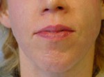 ThermaCool Non-Surgical Facelift Before and after photo