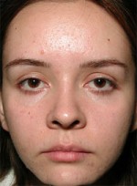 ThermaCool Non-Surgical Facelift