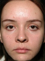 ThermaCool Non-Surgical Facelift Before and after photo