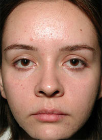 ThermaCool Non-Surgical Facelift before and after photo