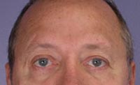 ThermaCool Non-Surgical Facelift before and after photo