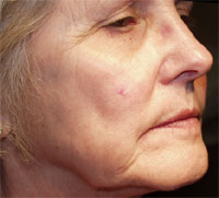 ThermaCool Non-Surgical Facelift before and after photo