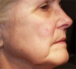 ThermaCool Non-Surgical Facelift Before and after photo