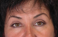 ThermaCool Non-Surgical Facelift before and after photo