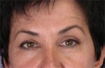 ThermaCool Non-Surgical Facelift Before and after photo