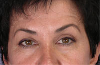 ThermaCool Non-Surgical Facelift before and after photo