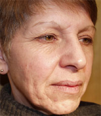 ThermaCool Non-Surgical Facelift before and after photo