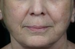 Laser Skin Resurfacing Before and after photo