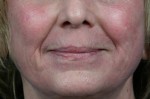 Laser Skin Resurfacing Before and after photo