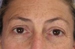 ThermaCool Non-Surgical Facelift Before and after photo