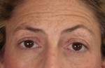 ThermaCool Non-Surgical Facelift Before and after photo