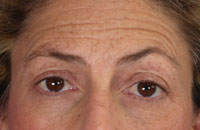 ThermaCool Non-Surgical Facelift before and after photo