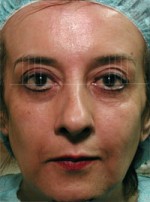 ThermaCool Non-Surgical Facelift