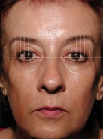 ThermaCool Non-Surgical Facelift Before and after photo