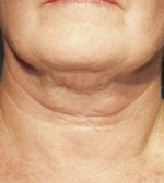 ThermaCool Non-Surgical Facelift Before and after photo