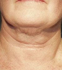 ThermaCool Non-Surgical Facelift before and after photo