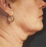 ThermaCool Non-Surgical Facelift