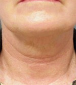 ThermaCool Non-Surgical Facelift Before and after photo