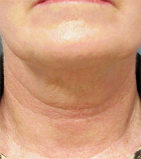 ThermaCool Non-Surgical Facelift before and after photo