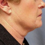 ThermaCool Non-Surgical Facelift