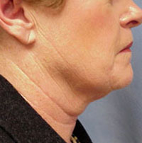 ThermaCool Non-Surgical Facelift before and after photo