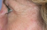 ThermaCool Non-Surgical Facelift Before and after photo