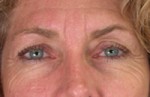 ThermaCool Non-Surgical Facelift Before and after photo