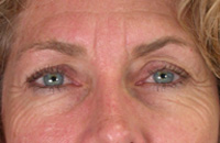 ThermaCool Non-Surgical Facelift before and after photo