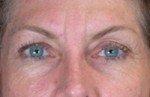 ThermaCool Non-Surgical Facelift Before and after photo