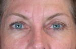 ThermaCool Non-Surgical Facelift