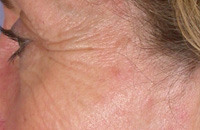 ThermaCool Non-Surgical Facelift before and after photo