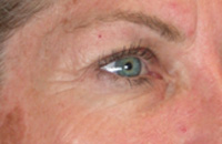 ThermaCool Non-Surgical Facelift before and after photo