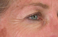 ThermaCool Non-Surgical Facelift before and after photo