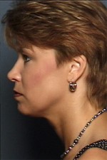 ThermaCool Non-Surgical Facelift Before and after photo