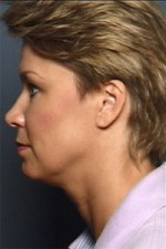 ThermaCool Non-Surgical Facelift Before and after photo