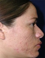 ThermaCool Non-Surgical Facelift