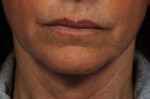 ThermaCool Non-Surgical Facelift