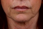 ThermaCool Non-Surgical Facelift Before and after photo