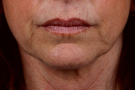 ThermaCool Non-Surgical Facelift before and after photo