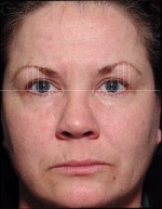 ThermaCool Non-Surgical Facelift