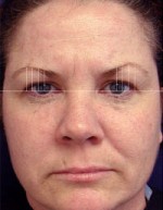 ThermaCool Non-Surgical Facelift Before and after photo