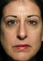 ThermaCool Non-Surgical Facelift