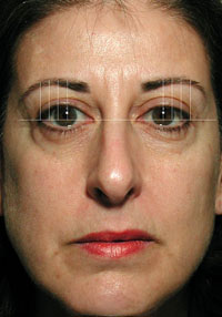 ThermaCool Non-Surgical Facelift before and after photo