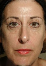 ThermaCool Non-Surgical Facelift