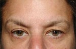 ThermaCool Non-Surgical Facelift Before and after photo