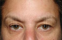 ThermaCool Non-Surgical Facelift before and after photo