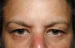 ThermaCool Non-Surgical Facelift Before and after photo