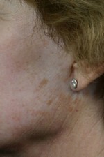 Laser Skin Resurfacing Before and after photo